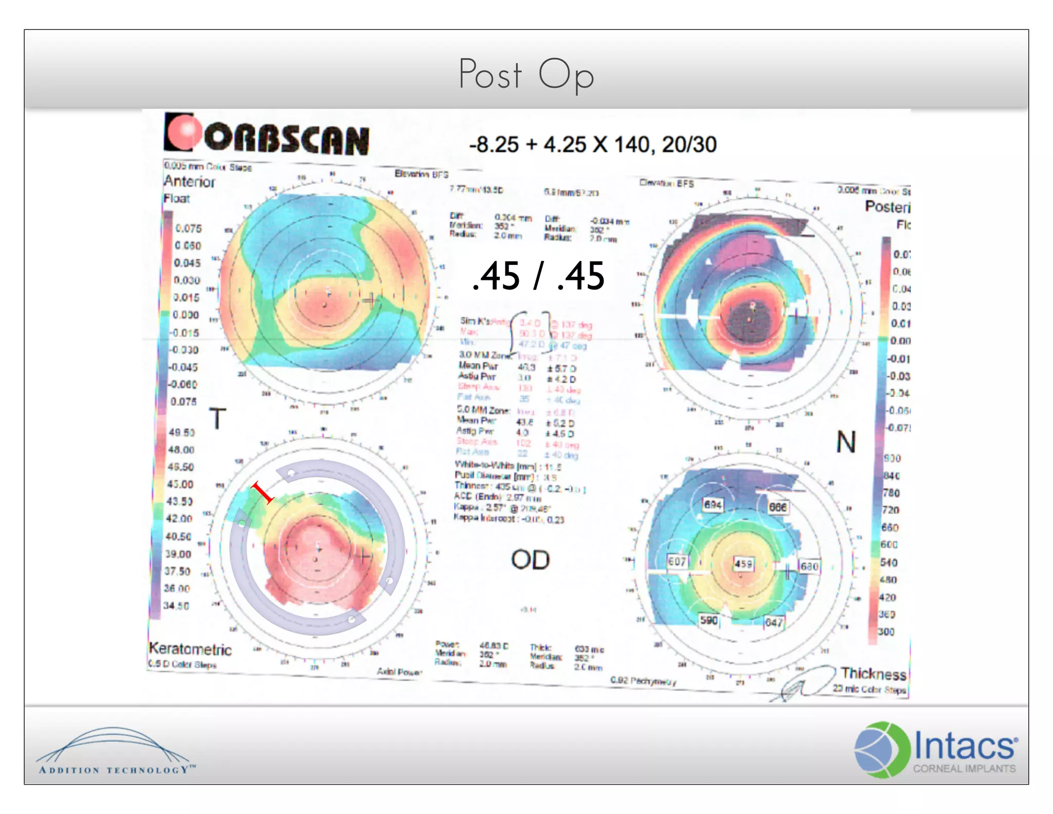Post Op



     .45 / .45
I!
 