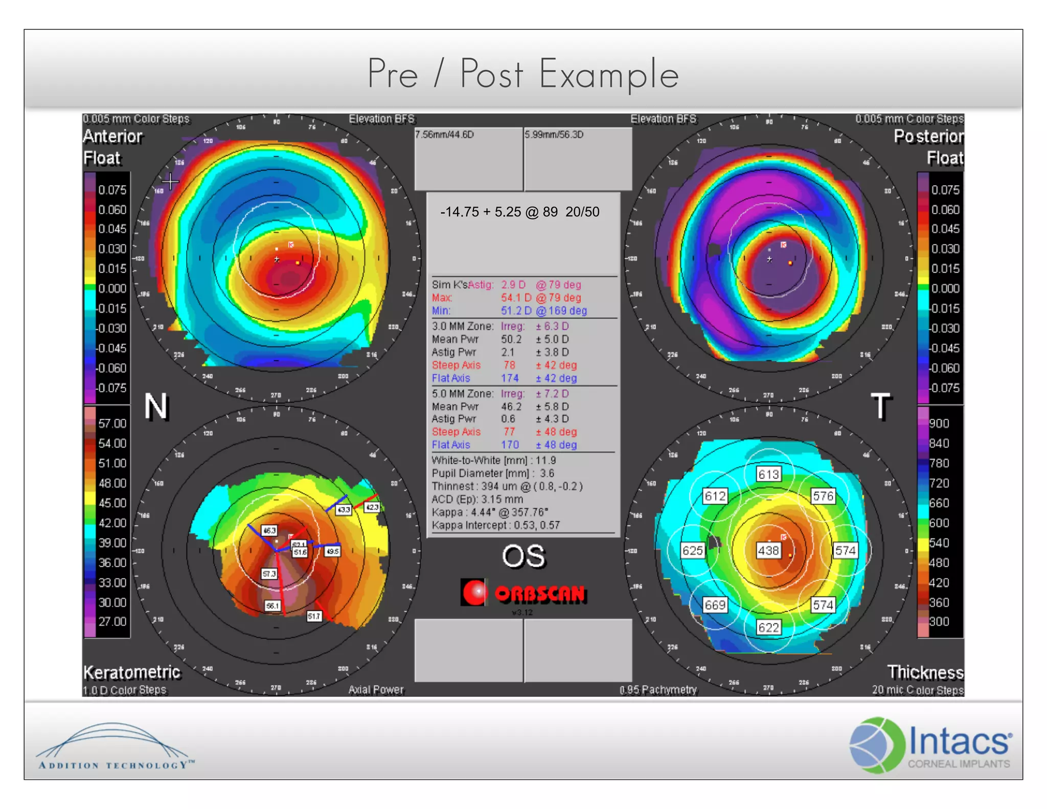 Pre / Post Example


    -14.75 + 5.25 @ 89 20/50
 