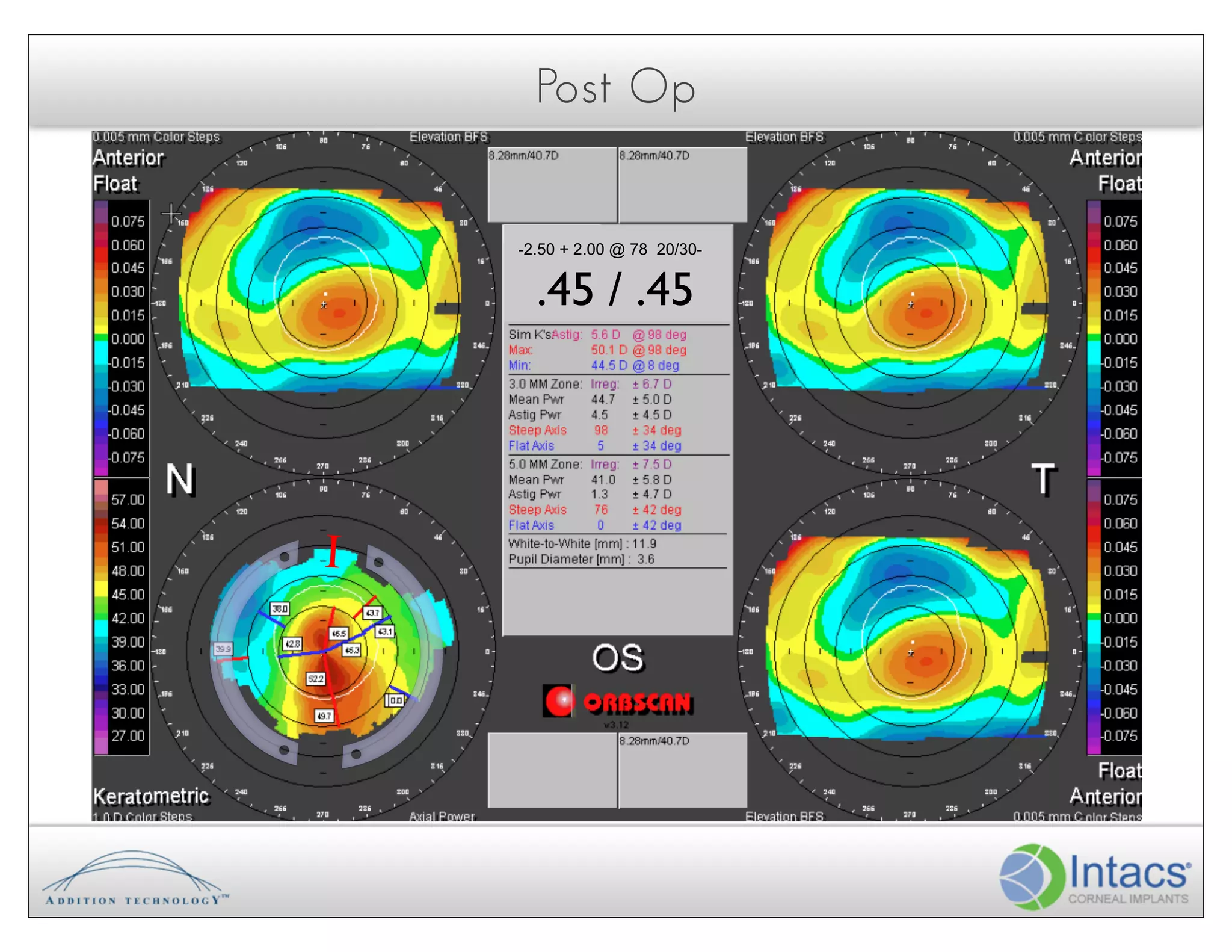 Post Op


     -2.50 + 2.00 @ 78 20/30-


       .45 / .45




I!
 