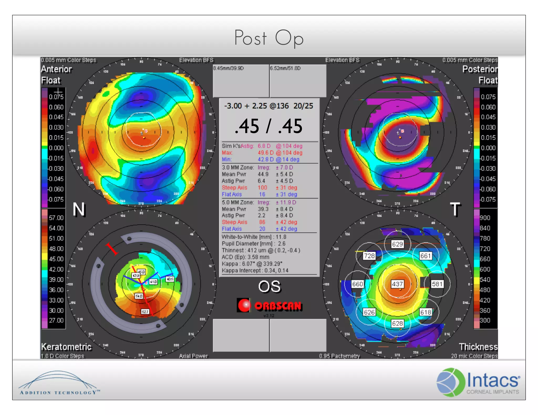 Post Op



     .45 / .45




I!
 
