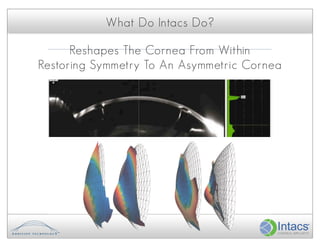 What Do Intacs Do?

      Reshapes The Cornea From Within
Restoring Symmetry To An Asymmetric Cornea
 
