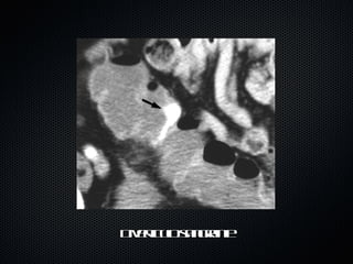 Diverticulo sangrante 