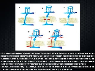 Mucosal and submucosal venous drainage is intermittently obstructed by muscular contraction or increased intraluminal pressure (panels A, B, and C). After many years of intermittent obstruction, submucosal veins may become dilated and tortuous (panel D) and involve additional veins and venules draining into the system. Eventually, the capillary ring dilates and the precapillary sphincter becomes incompetent resulting in a small arteriovenous communication lesion. Boley, SJ, Sammartano, R, Adams, R, et al. On the nature and etiology of vascular ectasias of the colon: Degenerative lesions of aging. Gastroenterology 1977; 72:650-660. 