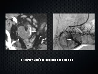 Extravasación intraluminal en ileon 