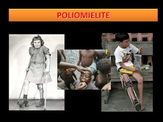POLIOMIELITE
 