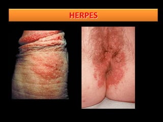 HERPES
 