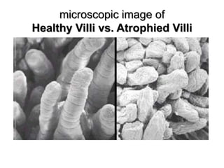 microscopic image ofHealthy Villi vs. Atrophied Villi
