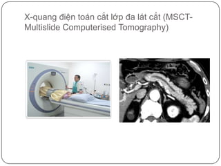 X-quang điện toán cắt lớp đa lát cắt (MSCT-Multislide Computerised Tomography)<br />