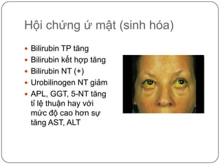 Hội chứng ứ mật (sinh hóa)<br />Bilirubin TP tăng<br />Bilirubin kết hợp tăng<br />Bilirubin NT (+)<br />Urobilinogen NT g...
