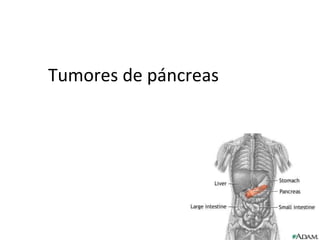 Tumores de páncreas
 
