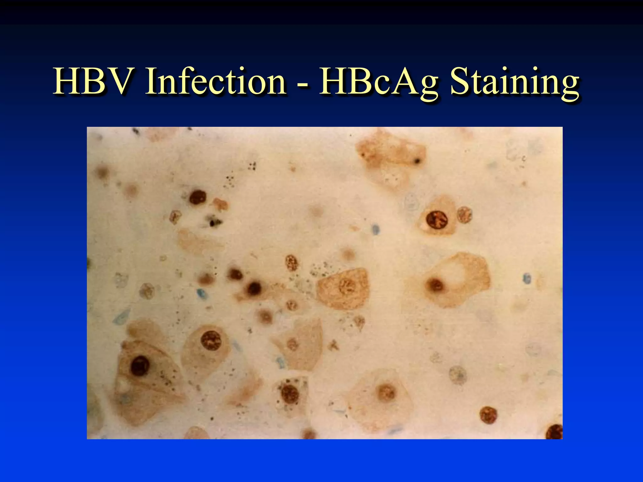 HBV Infection - HBcAg Staining
 
