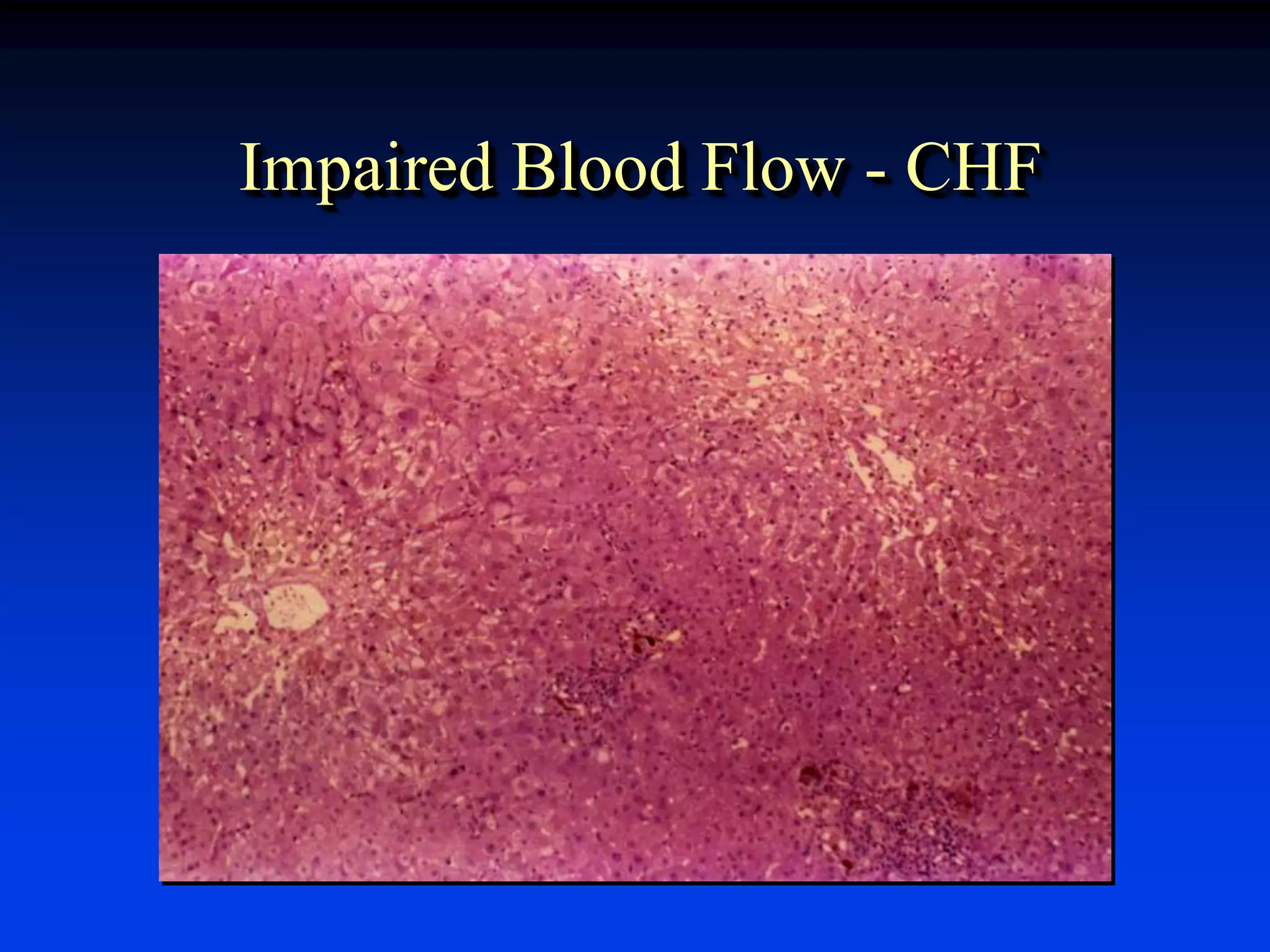 Impaired Blood Flow - CHF
 