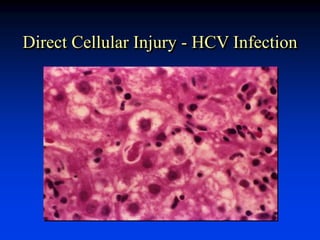 Direct Cellular Injury - HCV Infection
 