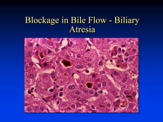 Blockage in Bile Flow - Biliary
Atresia
 