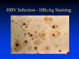 HBV Infection - HBcAg Staining
 