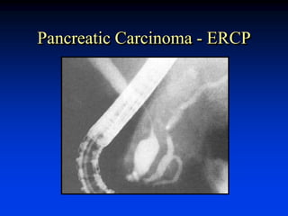 Pancreatic Carcinoma - ERCP
 