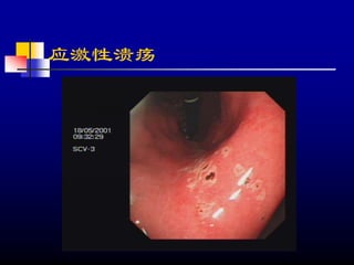 应激性溃疡
 
