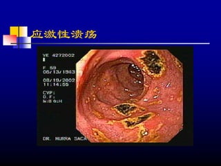 应激性溃疡
 