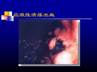 应激性溃疡出血
 