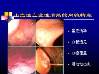 出血性应激性溃疡的内镜特点

         基底洁净

         血管透见

         血痂覆盖

         活动性出血
 