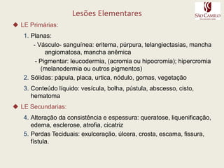 Lesões ElementaresLE Primárias:Planas: - Vásculo- sanguínea: eritema, púrpura, telangiectasias, mancha angiomatosa, mancha anêmica- Pigmentar: leucodermia, (acromia ou hipocromia); hipercromia (melanodermia ou outros pigmentos)Sólidas: pápula, placa, urtica, nódulo, gomas, vegetaçãoConteúdo líquido: vesícula, bolha, pústula, abscesso, cisto, hematomaLE Secundarias:Alteração da consistência e espessura: queratose, liquenificação, edema, esclerose, atrofia, cicatrizPerdas Teciduais: exulceração, úlcera, crosta, escama, fissura, fístula.