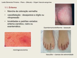 Lesão Elementar Primária – Plana – (Mácula) – Origem Vasculo-sanguínea1.1. EritemaMancha de coloração vermelha vasodilatação : desaparece a dígito ou vitropressãotonalidades e padrões variados: eritema cianótico, rubro ou exantemático. Examtemamorbiliforme - kawasakimeningococciemiaVasculite – cianose de extremidade