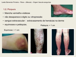 Lesão Elementar Primária – Plana – (Mácula) – Origem Vasculo-sanguínea 1.2. Púrpura    Mancha vermelho-violácea 