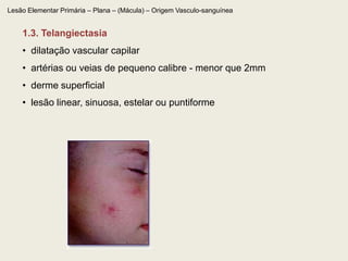   não desaparece à digito ou vitropressão