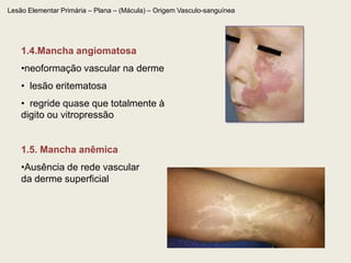   sangue extravascular :  extravasamento de hemácias na derme