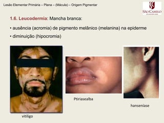   equimoses e petéquias.Petéquia: < 1 cmEquimose: > 1 cm