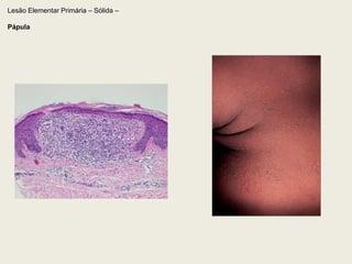   lesão linear, sinuosa, estelar ou puntiformeLesão Elementar Primária – Plana – (Mácula) – Origem Vasculo-sanguínea1.4.Mancha angiomatosaneoformação vascular na derme