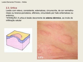   regride quase que totalmente à digito ou vitropressão1.5. Mancha anêmicaAusência de rede vascular da derme superficialLesão Elementar Primária – Plana – (Mácula) – Origem Pigmentar1.6. Leucodermia: Mancha branca: ausência (acromia) de pigmento melânico (melanina) na epiderme