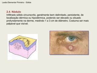  diminuição (hipocromia)Ptiriasealbahanseníasevitiligo
