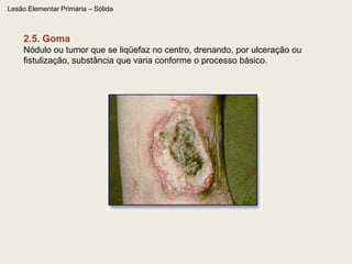 Lesão Elementar Primária – Plana – (Mácula) – Origem Pigmentar1.7. Hipercromia  depósito de pigmento (melanina ou outro pigmento) 