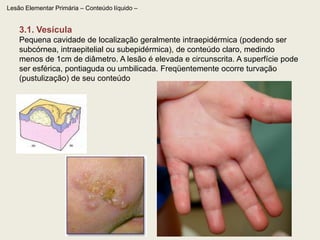  localizada (cloasma, eritema pigmentar fixo)