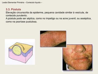 Lesão Elementar Primária 2. Sólidas:PápulaPlacaUrticaNódulo Gomas  Vegetação