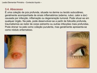 Lesão Elementar Primária – Sólida2.1. Pápula Lesão sólida e circunscrita