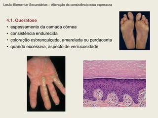  epidérmica, dérmica ou mista.Lesão Elementar Primária – Sólida – Pápula