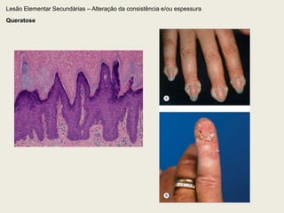 Lesão Elementar Primária – Sólida2.2 . PlacaLesão elevada, maior que 1cm, geralmente de superfície plana.A superfície da placa pode ser também descamativa, crostosa, queratinizada ou macerada.Pode ser constituída pela confluência de várias pápulas (placa papulosa).O termo "placa" também é empregado para a confluência de máculas, sendo então denominada a lesão placa maculosa. 