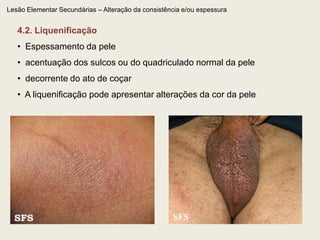 Lesão Elementar Primária – Sólida2.3. UrticaLesão com relevo, consistente, edematosa, circunscrita, de cor vermelho-róseo ou branco-porcelana, efêmera, circundado por halo eritematoso ou anêmico.*ATENÇÃO: A urtica é lesão decorrente de edema dérmico, ao invés de infiltração celular 