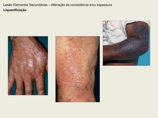 Lesão Elementar Primária – Sólida2.4. NóduloInfiltrado sólido circunscrito, geralmente bem delimitado, persistente, de localização dérmica ou hipodérmica, podendo ser elevado ou situado profundamente na derme, medindo 1 a 3 cm de diâmetro. Costuma ser mais palpável que visível.