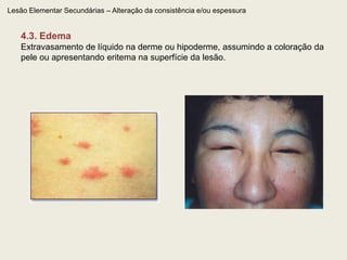 Lesão Elementar Primária – Sólida2.5. GomaNódulo ou tumor que se liqüefaz no centro, drenando, por ulceração ou fistulização, substância que varia conforme o processo básico.  