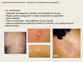 Lesão Elementar Primária – Sólida2.6. VegetaçãoPápula elevada, pediculada ou não, de superfície irregular.Pode ser recoberta por superfície queratósica dura, inelástica e amarelada, recebendo o nome de verrucosidade ou lesão verrucosa.  