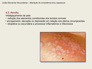 Lesão Elementar Primária 3. Conteúdo líquido VesículaBolhaPústula AbscessoCistoHematoma