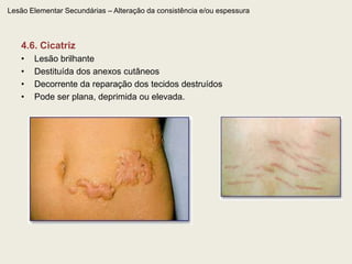 Lesão Elementar Primária – Conteúdo líquido – 3.1. VesículaPequena cavidade de localização geralmente intraepidérmica (podendo ser subcórnea, intraepitelial ou subepidérmica), de conteúdo claro, medindo menos de 1cm de diâmetro. A lesão é elevada e circunscrita. A superfície pode ser esférica, pontiaguda ou umbilicada. Freqüentemente ocorre turvação (pustulização) de seu conteúdo 