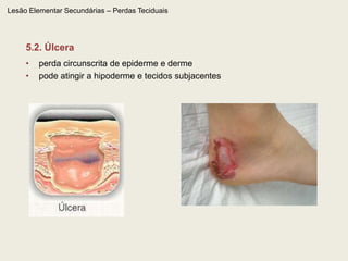 Lesão Elementar Primária – Conteúdo líquido – 3.4. AbscessoÉ uma coleção de pús profunda, situada na derme ou tecido subcutâneo, geralmente acompanhada de sinais inflamatórios (edema, rubor, calor e dor) causada por infecção, inflamação ou degeneração tumoral. Pode situar-se em qualquer órgão. Na pele, pode desenvolver-se a partir de foliculite profunda, traumatismos ao redor de corpo estranho ou outras infecções mais profundas. Pode drenar na pele como coleção purulenta, mas geralmente apresenta-se como nódulo eritematoso.