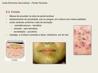 Lesão Elementar Primária – Conteúdo líquido – 3.5. CistoCavidade revestida por epitélio*, cujo conteúdo varia de líquido a pastoso. São tumores benignos relativamente comuns, derivados de anexos cutâneos, encontrados especialmente no couro cabeludo e no tórax. São geralmente solitários ou aparecem em pequeno número.Cistos múltiplos aparecem na acne e em alguns distúrbios específicos (esteatocistoma múltiplo), bem como em locais específicos (cistos escrotais). A pele que recobre o cisto é móvel, exceto nas proximidades do pequeno orifício central.Esse orifício existe na maioria dos cistos epidermóides e por ele podem entrar bactérias e haver extravasamento do conteúdo gorduroso, com queratina.* (dependendo de local do cisto, o epitélio poderá ser glandular ou queratinizado)