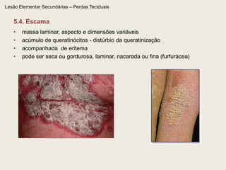 Lesão Elementar Primária – Conteúdo líquido – 3.6. hematomaColeção sangüínea localizada na derme ou tecido subcutâneo, geralmente restrita ao local do trauma. 