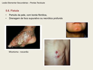 Lesão Elementar Secundárias – Alteração da consistência e/ou espessura4.1. Queratose  espessamento da camada córnea