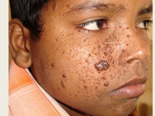   consistência endurecida